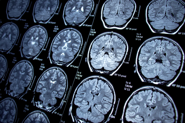 Photo showing a series of brain scan DICOM images in TrialKit PACS